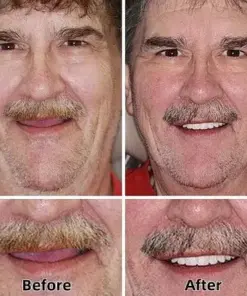 TAILEDEN™-Advanced Custom-Fit Functional Dentures