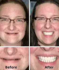 TAILEDEN™-Advanced Custom-Fit Functional Dentures