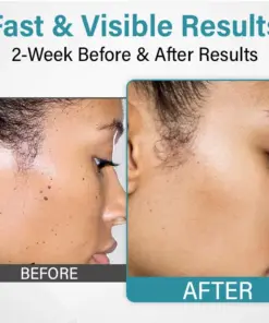 TAILEDEN Painless Laser Mole Removal Pen