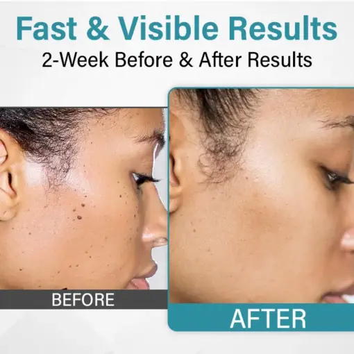 TAILEDEN Painless Laser Mole Removal Pen