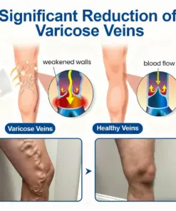 TAILEDEN® VeinEase Microneedle Care PatchInstant Relief, Long-Term Results