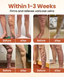 TAILEDEN™ VeinTarget Microneedle Patch