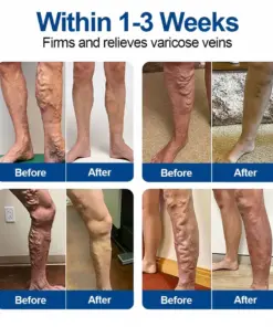 TAILEDEN® VeinEase Microneedle Care Patch