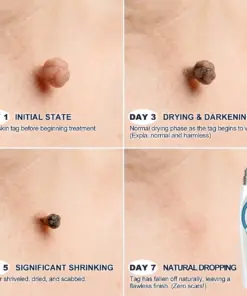 TAILEDEN® 7-Day Skin Tag & Spot Eraser Painless & Scar-Free Advanced Imperfection Removal Rollerball Pen