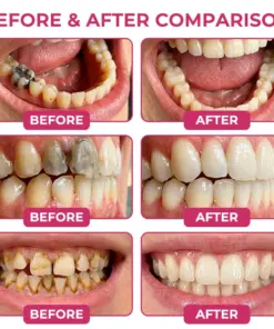 TAILEDEN® Cavity-Repair Natural Enamel Filling Gel