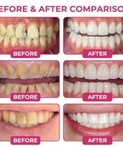 TAILEDEN® Cavity-Repair Natural Enamel Filling Gel